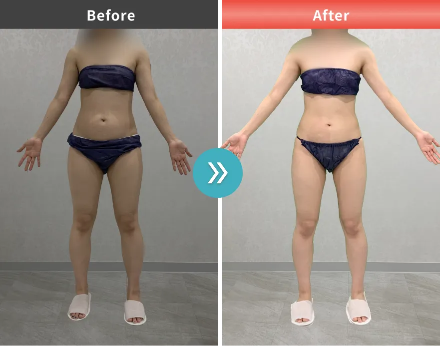 症例No.00032｜66.7kg→58.2㎏（20代女性・167cm）