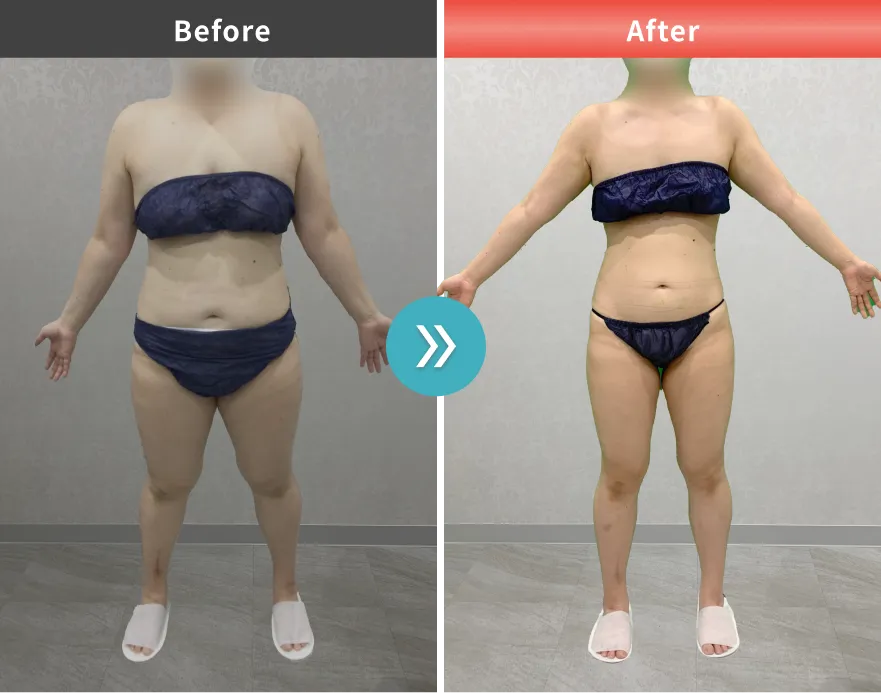 症例No.00026｜85.0kg→69.9kg（20代女性・168cm）
