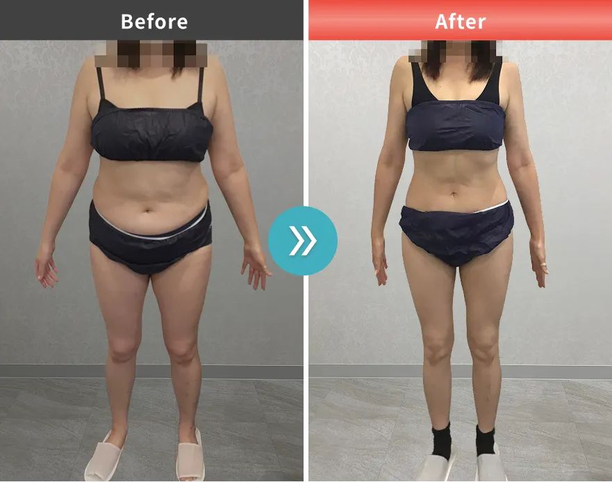 症例No.00063｜68.0kg→52.4kg（40代女性・162㎝）