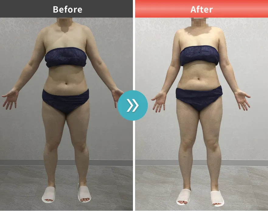 医療痩身・医療ダイエットの症例No.0069｜72.5kg→65.6kg（160cm・30代女性）