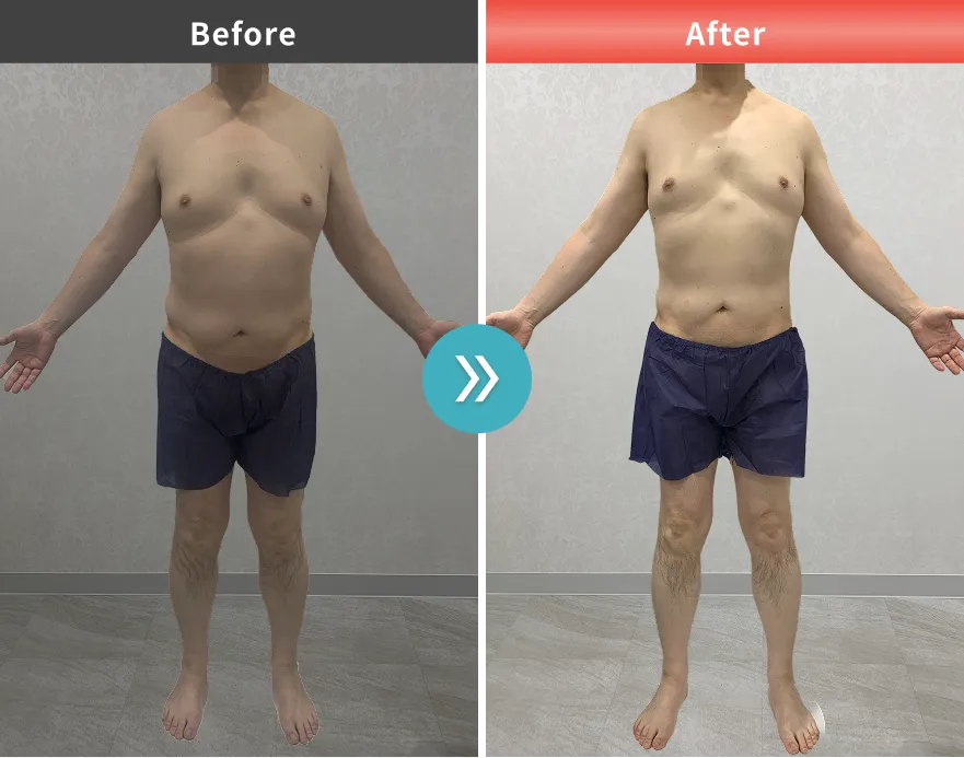 医療痩身・医療ダイエットの症例No.0079｜90.6kg→84.2kg（50代男性・176cm）