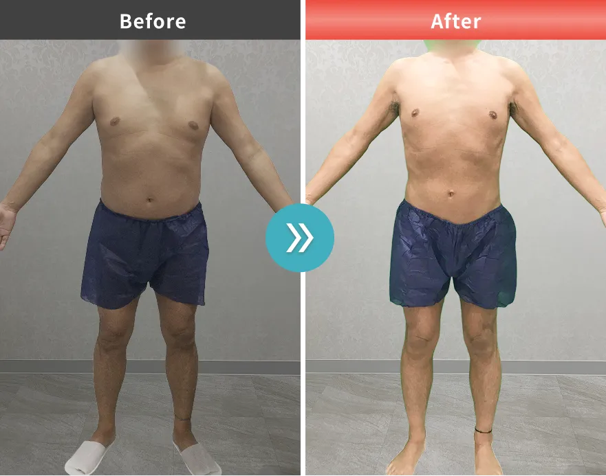 医療痩身・医療ダイエットの症例No.0085｜81.9kg→68.7kg（50代男性・170cm）