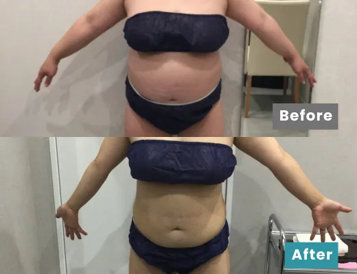 医療痩身・医療ダイエットの症例No.0064｜76.5kg→62.4kg（149.5cm・30代女性）