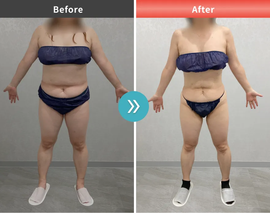 症例No.00113｜69.4kg→54.8kg（50代女性・156.5cm）