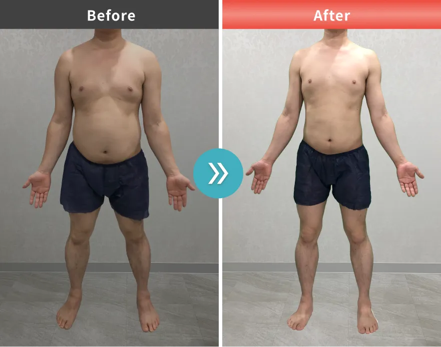症例No.00161｜95.4kg→77.7kg（30代男性・178cm）