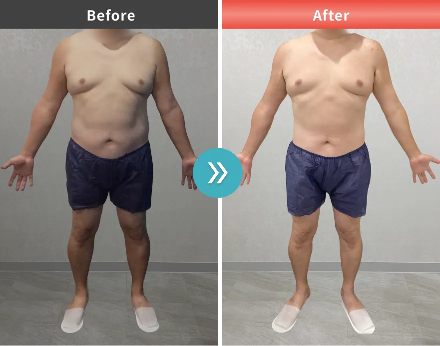 症例No.00167｜104.1kg→90.3kg（40代男性・177cm）