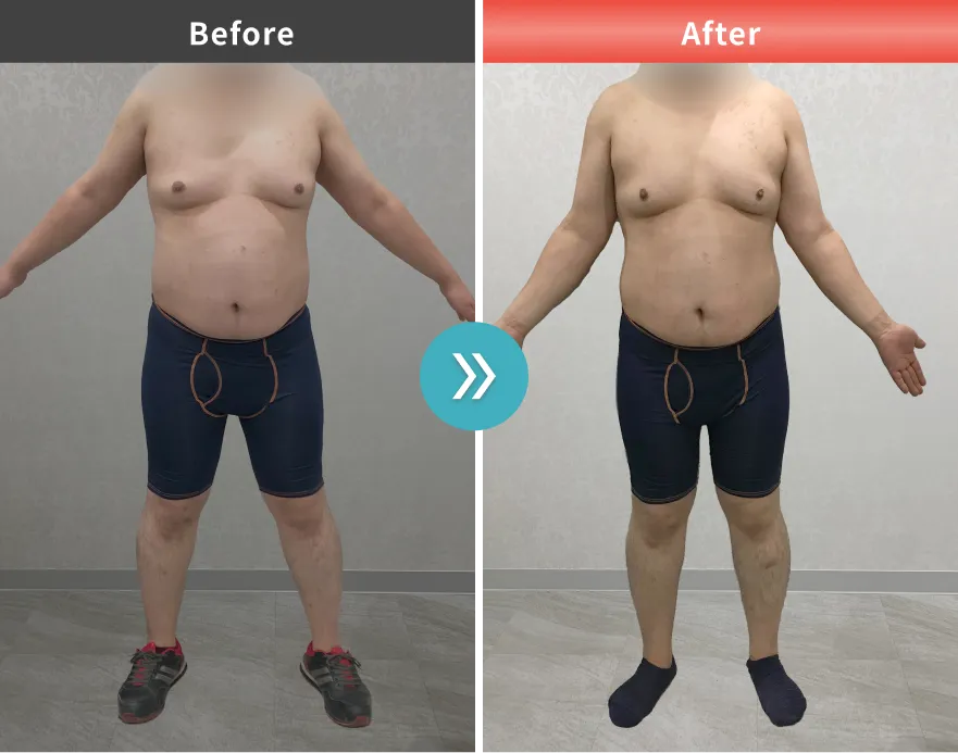 症例No.00169｜110.5kg→100.2kg（20代男性・180cm）