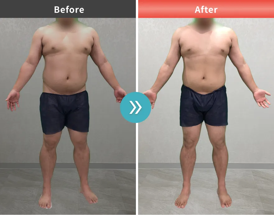 症例No.00170｜113.5kg→101.1kg（30代男性・175cm）