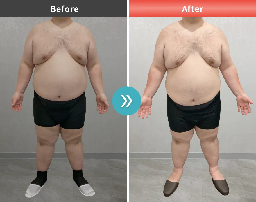 症例No.00172｜152.4kg→141.2kg（30代男性・168cm）