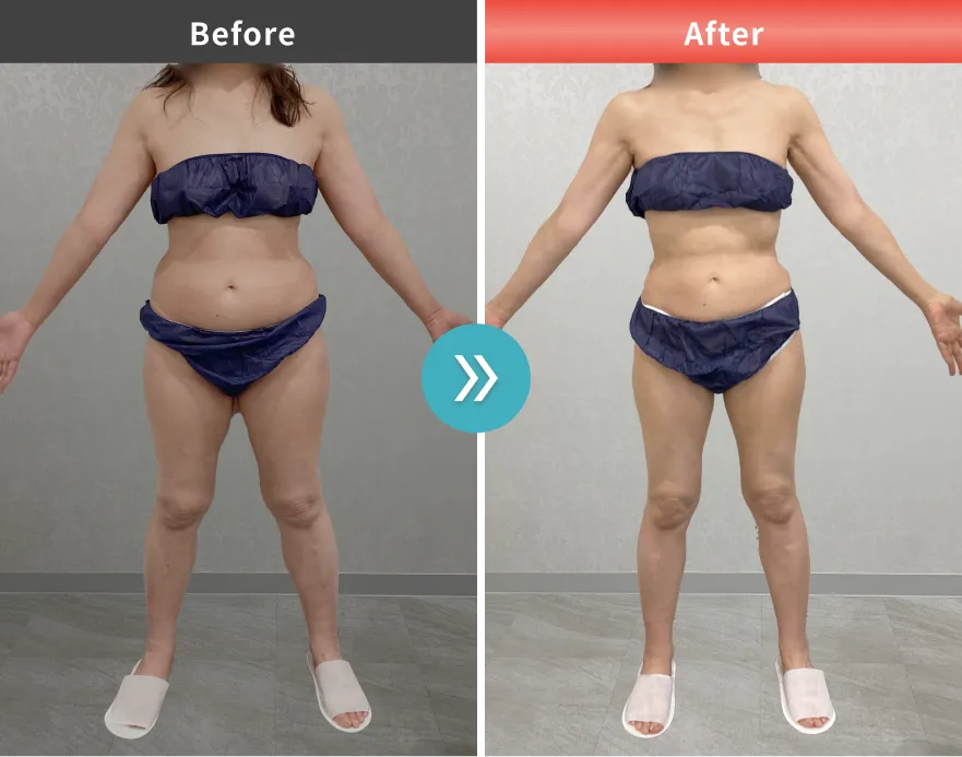 症例No.00173｜64.0kg→51.6kg（50代女性・162.8cm）