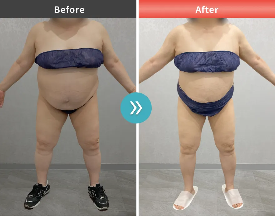 症例No.00174｜79.7kg→69.1kg（60代女性・148cm）