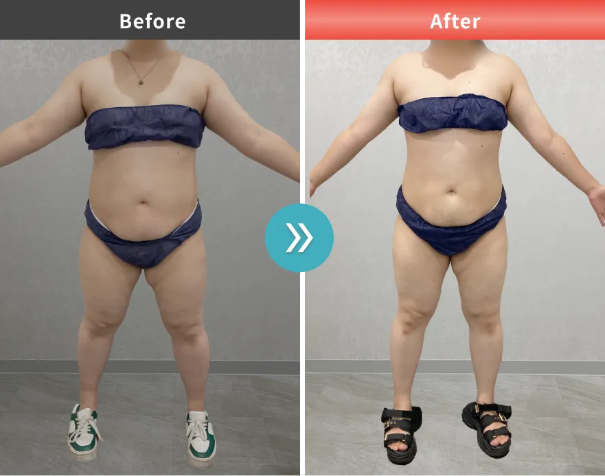 症例No.00175｜85.3kg→74.4kg（30代女性・161cm）