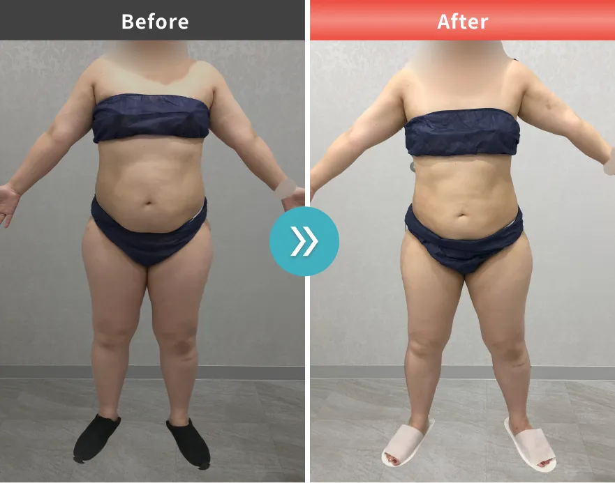 症例No.00176｜82.0kg→69.9kg（40代女性・159cm）