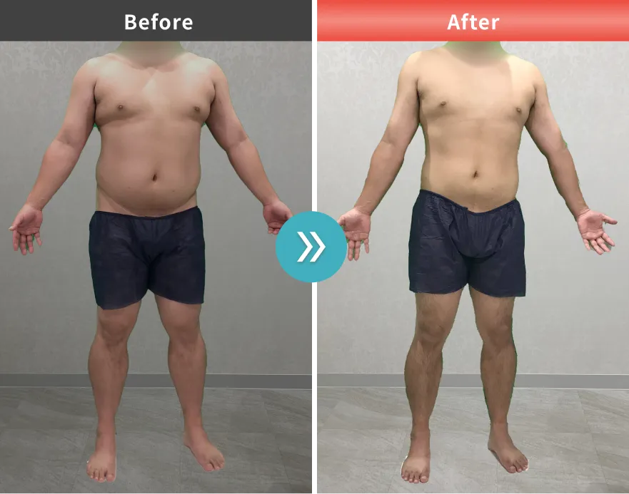 症例No.00179｜113.5kg→91.5kg（30代男性・175cm）