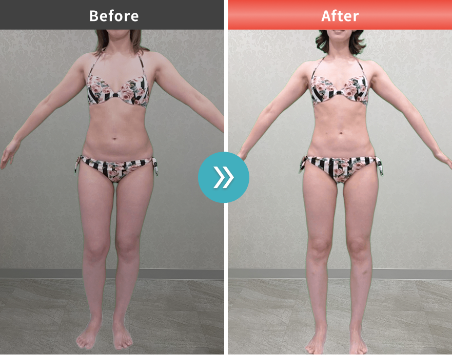 症例No.00177｜54.2kg→48.7kg【堀口ミイナ様】（30代女性・160cm）