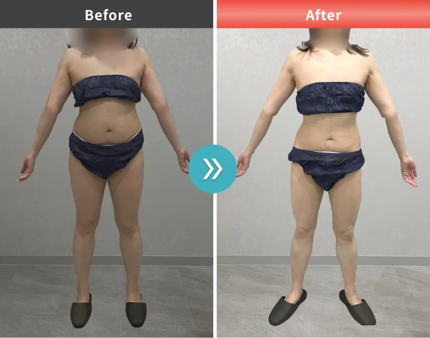 症例No.00184｜61.5kg→50.7kg（40代女性・162cm）