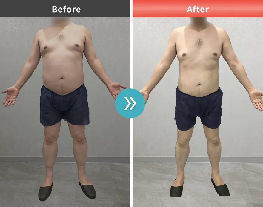 症例No.00186｜96.4kg→81.2kg（50代男性・174cm）