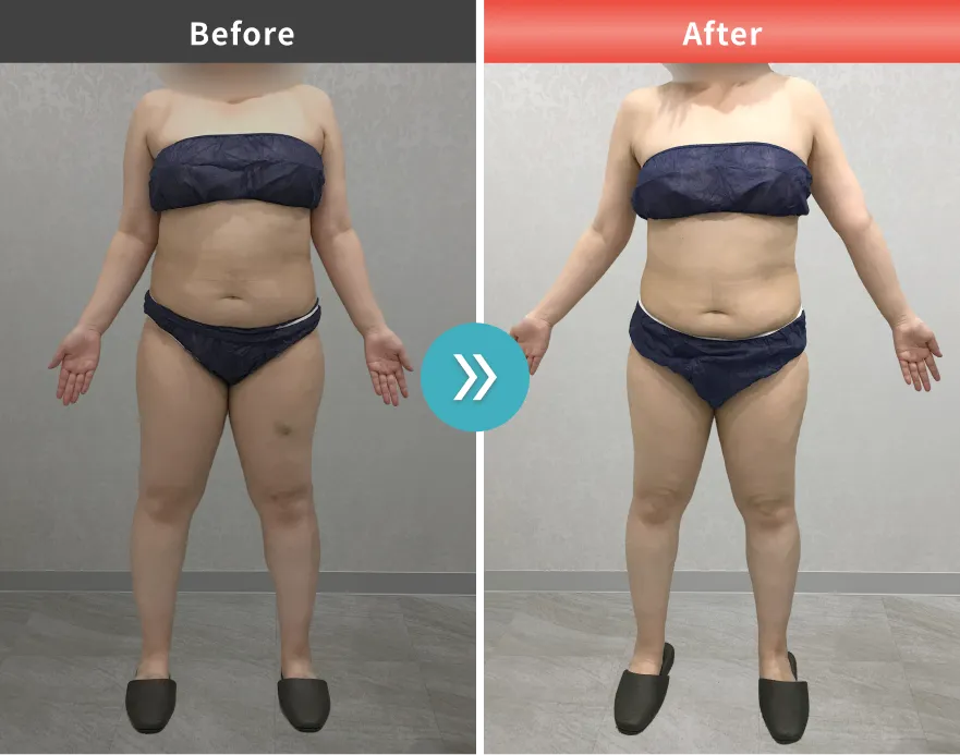 症例No.00187｜74.4kg→62.9kg（30代女性・158cm）
