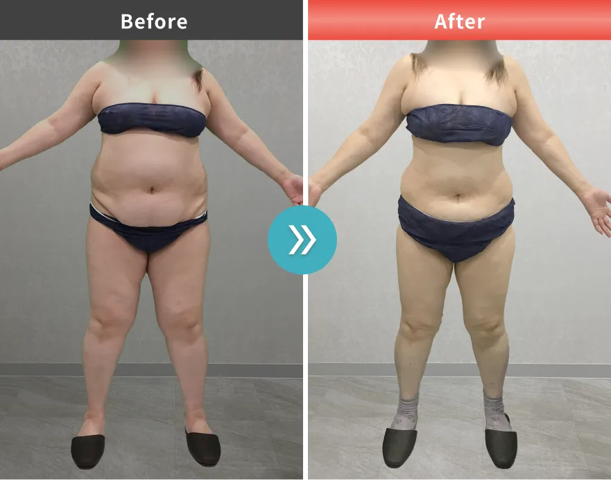 症例No.00189｜84.7kg→72.3kg（50代女性・161cm）