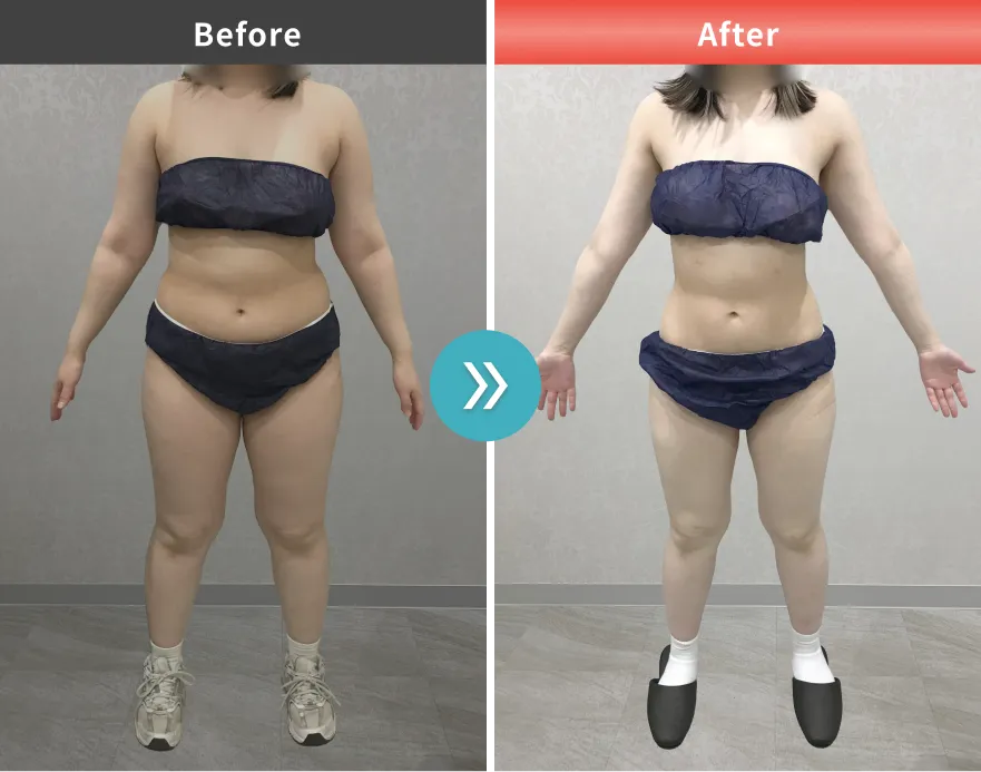 症例No.00200｜72.3kg→55.5kg（20代女性・160cm）
